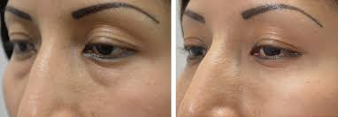 These nasal cannulas have a soft, clear cushion design that supports the nasal prongs to optimize patient comfort. Hyaluronic Acid Fillers Clinics In Plastic Surgery