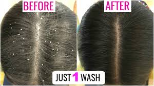 Simple science behind dandruff and itchy scalp. Apply This Once Get Rid Of Dandruff Itchy Scalp Anaysa Youtube
