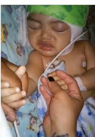 Craniosynostosis Surgery