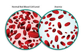 Image result for Anemia