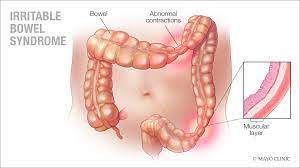 Myotherapy For Ibs Constipation Ronald Myotherapist