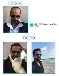 Before After Hair Transplantation Prima E Dopo Sacekimi Sacekimiuzmani Sacekimmerkezi Sacekimioncesi Sacekimisonrasi Drserkanaygin Hairtransplant Sac