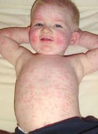 Tips To Recognize Common Fever And Rashes In Children Rashes In Children Kids Health Kids