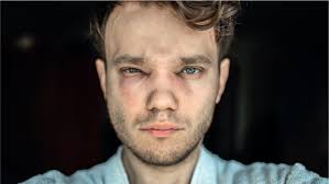 Food allergy—care and management