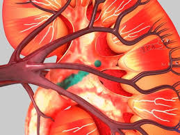 Chronic renal failure is a condition involving a decrease in the kidneys' ability to filter waste and fluid from the blood. Dosing Errors Occur Frequently In Patients With Renal Failure