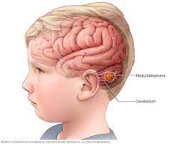 One red flag to watch out for: Brain Tumor Symptoms And Causes Mayo Clinic