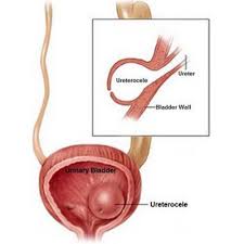 Ectopic Ureter Medicina Anatomiya Plakat