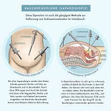 Quem tem endometriose pode engravidar? Laparoskopie Endometriose Vereinigung Deutschland E V