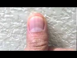 Tiny black lines or dots under nail can simply be as a result of an injury a nail infection or different underlying medical condition. Black Line Under Finger Nail Cancer Heart Disease Or Vitamin Deficiency Or Melanoma Youtube