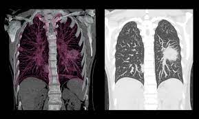 A ct scan might give more information about whether and how the myeloma is affecting your bones. Mesothelioma Imaging And Diagnostics What To Look For Imaging Technology News