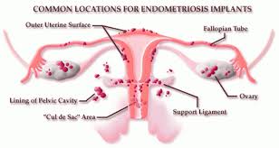 Difficile de s'y retrouver avec toute la panoplie d'huile qui nous sont offertes sur les marchés. Les Causes Et Les Remedes Pour L Endometriose Ameliore Ta Sante