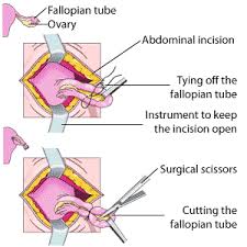 Tubal Ligation Medbroadcast Com