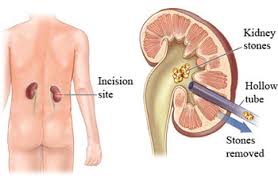 Treatments Of Mini Pcnl Flexible Nephroscopy Standards Pcnl Plus Laser Lithotripsy