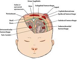 Image result for Vacuum Caput