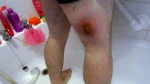 Disgusting moment man squeezes ingrown hair on his friend's back, causing puss to squirt everywhere. Ingrown Hair On Toe