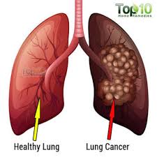 Squamous cell carcinoma of the lungs Are Non Smokers Safe From Lung Cancer Steemit