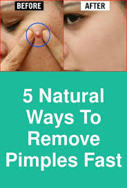 5 Natural Ways To Remove Pimples Fast All Of Us Want That Pimple To Just Vanish As Soon As P How To Remove Pimples Remove Pimples Overnight How To Cure Pimples