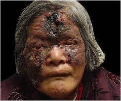 The centre has also asked doctors to look. Successful Treatment Of A Patient With Cutaneous Co Infection Caused By Mucor Irregularis And Klebsiella Pneumoniae