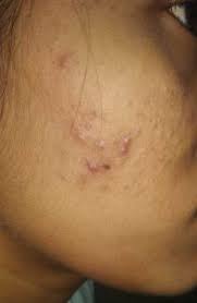 Here we talk about side effects, skin progress and. 4 Stages Of Acne And Its Treatment Tibot
