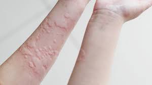 Image result for skin rash similar to scabies