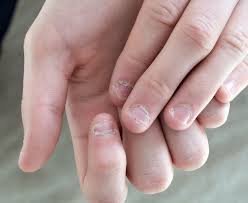 Mit dem fingernagel den oberen teil der klammer in der in abbildung 2 gezeigten richtung herausziehen. Langsrillen Flecken Co Nagelkrankheiten Erkennen