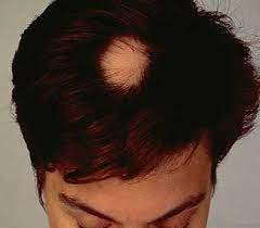 Le manifestazioni dell'alopecia androgenetica risultano diverse nei due sessi. L Alopecia Areata La Caduta Di Capelli A Chiazze