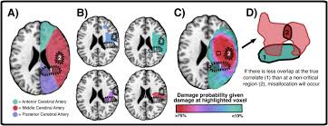 Image result for Neurologic Lesion Localization
