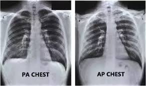 I'm curious about it because the result of xray says that there is nodulohazy densities in the right. What Is The Difference Between An Ap And A Pa View Of An X Ray Quora