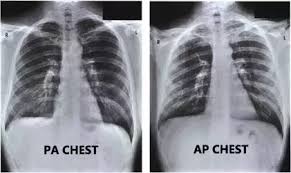 What does nodulohazy densities mean? What Is The Difference Between An Ap And A Pa View Of An X Ray Quora
