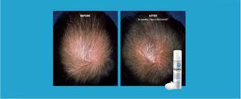 The other mistake people usually make is that they get panicked and stop using the product after seeing increased hair loss. Amazon Com Men S Rogaine 5 Minoxidil Foam For Hair Loss And Hair Regrowth Topical Treatment For Thinning Hair 3 Month Supply Pack Of 3 Beauty