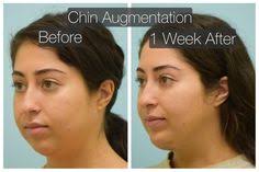 37 Best Chin Implant Images In 2019 Chin Implant Facial