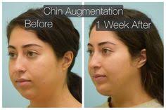 37 best chin implant images in 2019 chin implant facial