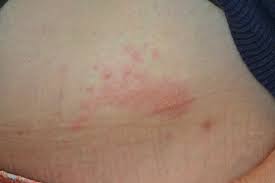 Image result for zoster under breasts