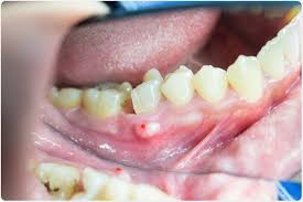 Image result for Periodontal Abscess