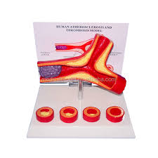We did not find results for: Modelo De Terapia Y Trombosis Arterial Humana Buy Modelo De La Seccion De La Arteria Arterioesclerosis Product On Alibaba Com