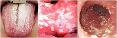 Image result for oral thrush symptoms roof of the mouth