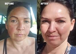 Fade Hyperpigmentation & Melasma