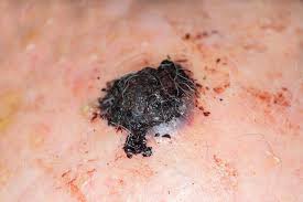 Psoriasis and skin cancer both change the skin's appearance. What Does Scalp Melanoma Look Like U S Dermatology Partners Blog