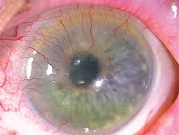 Image result for Cornea