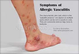Anti Aging Medication Reviewsantiagingcreams Refferal 5638048342 Bestantiagingskincream Hypersensitivity Vasculitis Autoimmune Allergic Reaction Rash