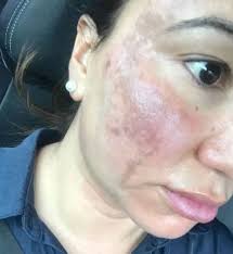 Unfortunately, you can still suffer from burns from laser hair removal. Woman Had To Avoid Sunlight For Months After Laser Hair Removal Left Her With Horrific Scars