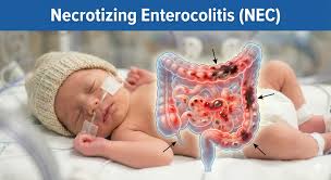 Image result for Necrotizing Enterocolitis