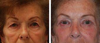 Blepharoplasty