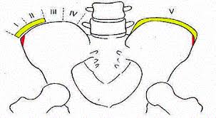 Image result for Risser Sign