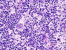 Klasik hodgkin lenfoma ve nodüler lenfosit ağırlıklı hodgkin lenfoma. Hodgkin Lymphoma Wikipedia