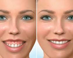How A Reverse Vestibuloplasty Lip Lowering Can Treat A Gummy Smile