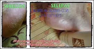 Kasut yang sesuai memainkan peranan yang penting dalam keselesaan tapak kaki. Cara Hilangkan Tumit Pecah Paling Mudah Berkesan Ohcantik Com