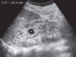 Autosomal Recessive Infantile Polycystic Kidney Disease Sciencedirect