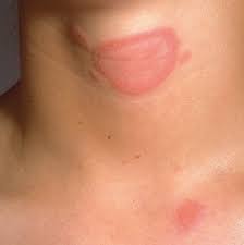 Hautpilze Diagnostik Und Behandlung Universitatsspital Zurich