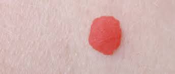 And, the tendency to develop cherry angiomas is believed to be genetic. Cherry Angiomas Red Spots Causes And Treatment Moyal Therapies